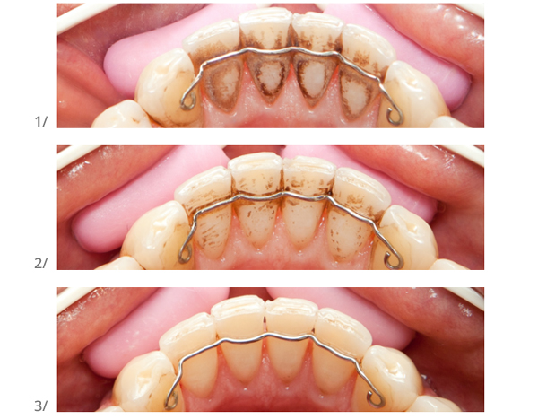 Ouvre-bouche En Silicone, écarteur De Joue Sûr Pour L'orthodontie 